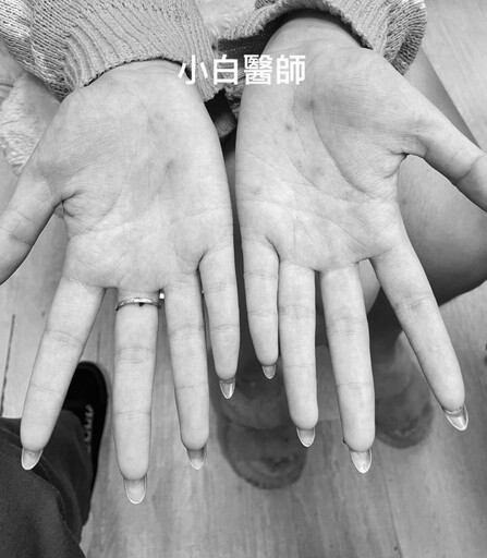 16歲妹手長水泡以為汗疹！「腳脫皮冒瘀青」嚇壞就醫 一驗竟是二期梅毒