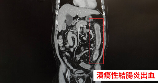 60歲男潰瘍性結腸炎擅自停藥 「血便、休克」搶救後脫離險境