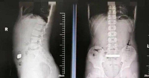 11歲弟腹脹送醫!X光驚見「高密度金屬」 醫取出100克金條傻眼
