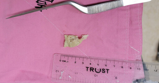 老翁嚴重鼻塞求助 醫師從鼻孔內抽出「一大坨」