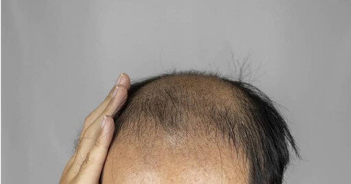 30多歲主管掉髮以為雄性禿!醫見「身上1特徵」驚覺不單純 一驗竟是梅毒