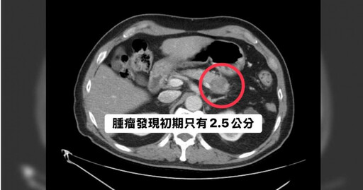 無菸酒及不適!60歲男罹癌王「腫瘤3月增1半」 醫示警:8成有高血糖