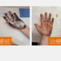 吹冷氣也狂噴汗！15歲妹「身飄異味」羞愧躲同學 手抹1物秒冒紫斑
