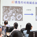 「台大AI助手」好給力 突破瓶頸！2分鐘揪出早期胰臟癌