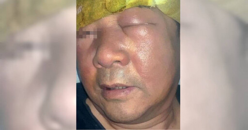 66歲男愛挖鼻孔引發「丹毒」！臉腫成豬頭睜不開眼 高風險族群曝光