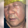 66歲男愛挖鼻孔引發「丹毒」！臉腫成豬頭睜不開眼 高風險族群曝光
