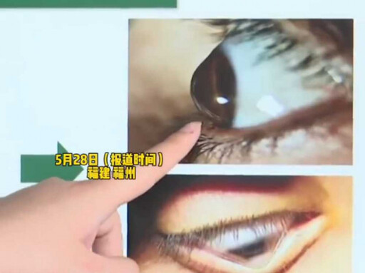 男子20天近視加深200度「角膜變圓錐形」 醫揭1習慣超危險