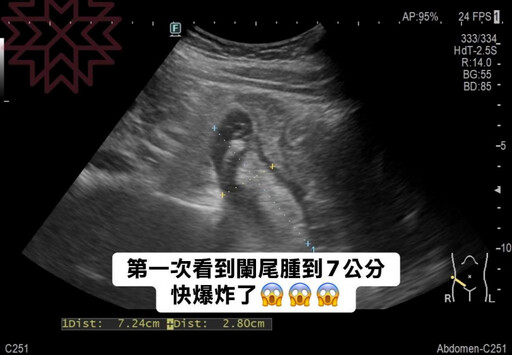 女子腹部痛到眼光泛淚「以為腸胃炎」 專業醫檢查驚見「腫到快爆裂」