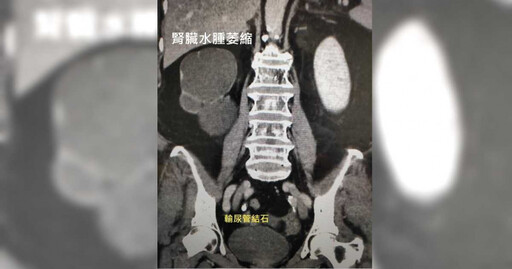 60多歲婦結石多年「以為會排出」 醫嘆:右腎壞光剩一層薄皮
