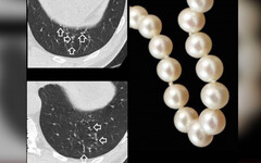 肺部出現30顆結節「如珍珠項鏈」！醫師親解真相：很安全