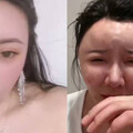 驚悚！陸正妹打生長因子想變更美 臉部「完全饅化」慘成面具人