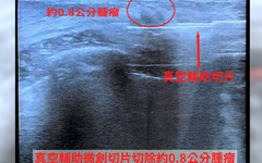 24歲嫩妹乳房疼痛！就醫驚見「0.8公分腫瘤」 醫曝致病1關鍵