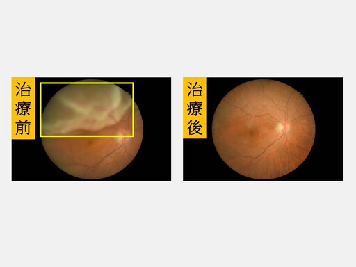 眼睛宛如「壁紙剝落」！OL睡醒突看不見 忽視3前兆險終身失明