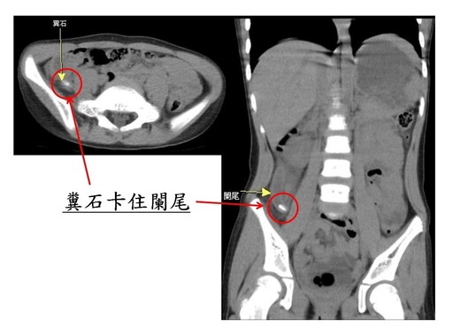 4歲女童「腹痛嘔吐」誤為腸胃炎 醫：罕見急性闌尾炎破裂合併腹膜炎