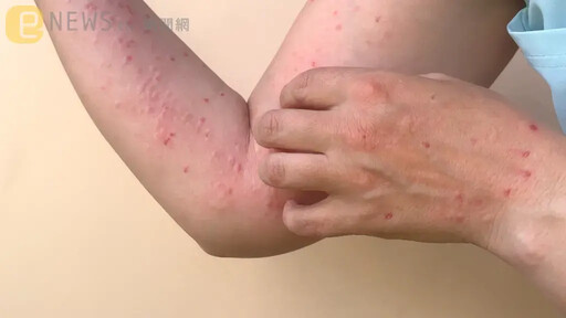 國內「再添2起」麻疹境外移入病例 皆自越南返台後發病確診