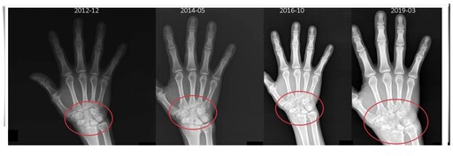 不痛就沒事？類風濕性關節炎「悄悄破壞」！醫提醒2件事