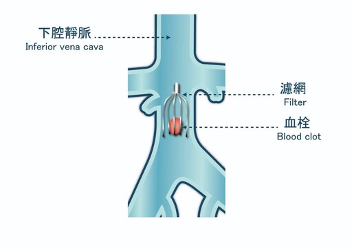 被忽視的靜脈殺手！久坐、飛行易罹患 醫示警：1徵兆恐致命