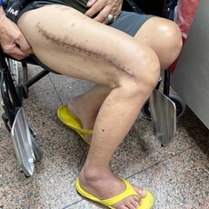 82歲老翁車禍「鋼板斷3截」！經3次手術 1個多月再參加媽祖遶境