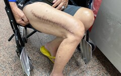 82歲老翁車禍「鋼板斷3截」！經3次手術 感動喊：明年要回去走媽祖