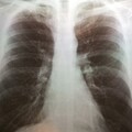 全球湧入大量「兒童白肺」！專家曝「4大擔憂」：無症狀、無明顯咳嗽 做2事防感染