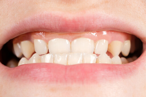 牙齦退縮不敢開口笑，該如何補救？牙醫盤點常見4原因，別用暴力刷牙