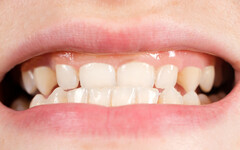 牙齦退縮不敢開口笑，該如何補救？牙醫盤點常見4原因，別用暴力刷牙
