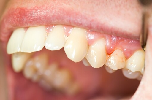 6旬老翁牙齦腫脹疑似腫瘤，檢查後竟是1疾病惹禍