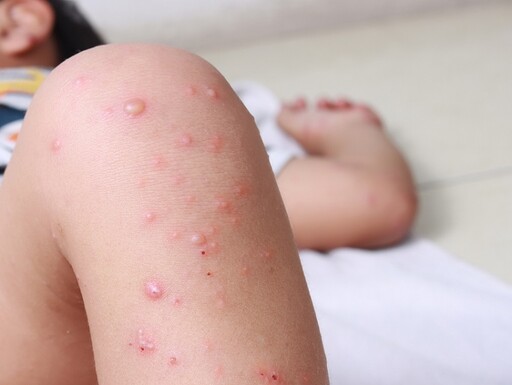 麻疹潛伏期高達12天！醫揭「常見5大症狀」易被忽略 不慎被傳染這樣做