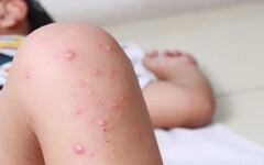 麻疹潛伏期高達12天！醫揭「常見5大症狀」易被忽略 不慎被傳染這樣做