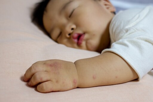 麻疹傳染力超強「全球病例恐激增」！醫點名「3種人」快打疫苗 6種人建議再補打一劑