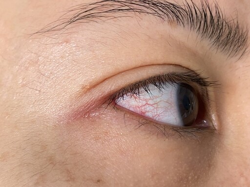 眼睛紅紅的但不痛！醫曝「6舉動」都可能害結膜下出血 便祕、咳嗽注意
