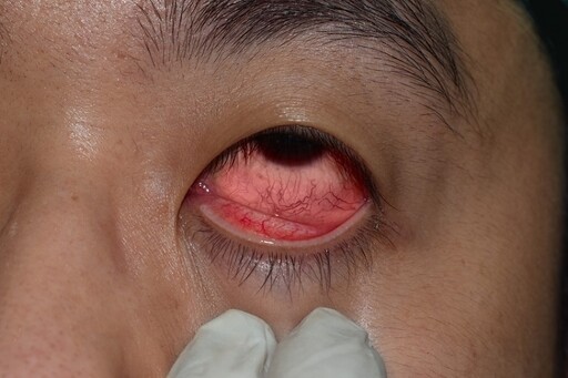 眼睛紅紅的但不痛！醫曝「6舉動」都可能害結膜下出血 便祕、咳嗽注意