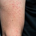 麻疹傳染力強，症狀類似感冒難辨別，無與麻疹病人直接接觸，竟然也被傳染