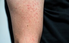 麻疹傳染力強，症狀類似感冒難辨別，無與麻疹病人直接接觸，竟然也被傳染