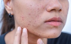 粉刺一直長！「3種除法」恐害皮膚變敏感 醫推2方式有效代謝