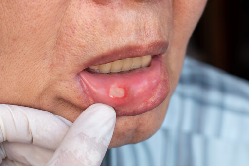 常常嘴破，可能不只是火氣大，恐為免疫問題警訊，引發口腔潰瘍6原因