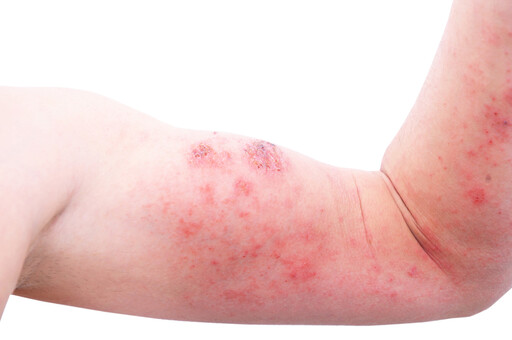 濕疹、皮膚炎還是過敏？濕疹到底是什麼？濕疹一定是濕的嗎？