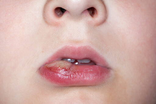 治療嘴破有4方法，牙醫師提醒:若超過2周未見好轉，盡快就醫