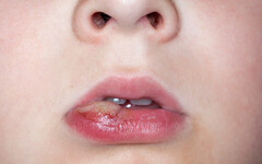 治療嘴破有4方法，牙醫師提醒:若超過2周未見好轉，盡快就醫