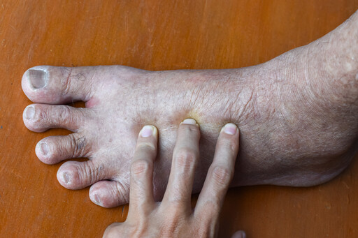 運匠香港腳沒看醫生，小腿紅腫像隻豬腳，竟是1疾病上身，嚴重恐截肢
