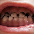 16歲高中生焦慮暴食，牙齒幾乎蛀光光，引發蜂窩性組織炎