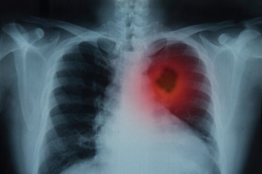 出現「杵狀指」是罹肺癌？ 醫解答揭「關鍵警示症狀」：多半都已經晚期階段了