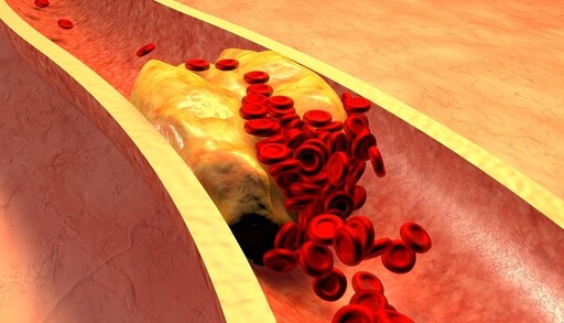 你以為最傷心血管健康的是脂肪嗎?其實這個恐比脂肪更該注意，還容易引發糖尿病