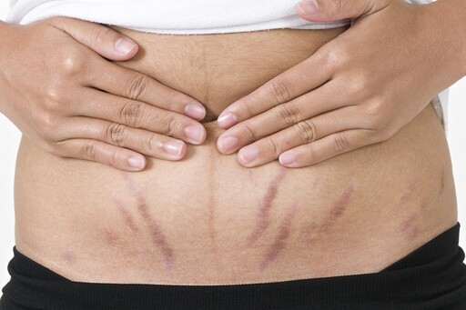 身體上的白色紋路是肥胖痕跡？醫揭5個真實原因 增肌太快、缺乏運動上榜