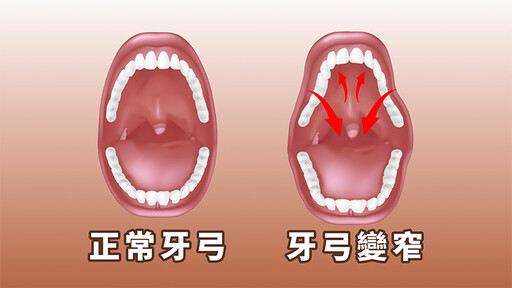 孩子暴牙是因為吸奶嘴惹禍？ 醫列「換牙期3重點建議」：不要躺著喝奶