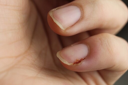 指甲「出現這些症狀」恐是皮膚癌！醫曝致病因 手指又比腳趾更常見