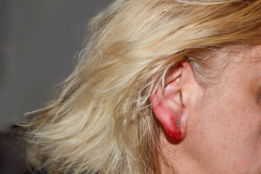 穿耳洞導致蟹足腫？醫師提醒：打洞後別忽略１件事，發現疤痕儘早就醫