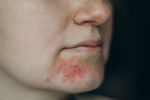 夏天臉紅通通可能是1疾病！醫師分享護膚妙招告別泛紅