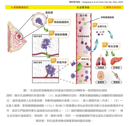 張金堅：變調的交響曲：乳癌轉移揭秘