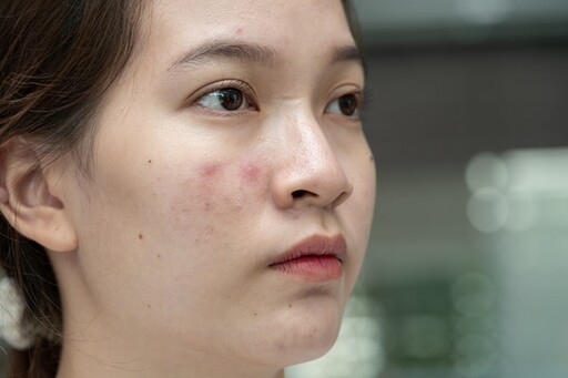 26歲女業務臉爛到不敢見人，醫揭2招逆轉肌膚危機